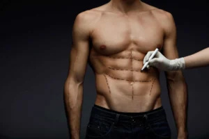 Liposuction in Dubai